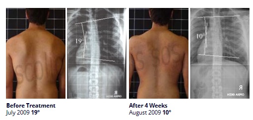 Before and After Scoliosis Treatment